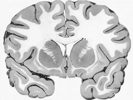 馬斯克腦機(jī)融合系統(tǒng)Neuralink