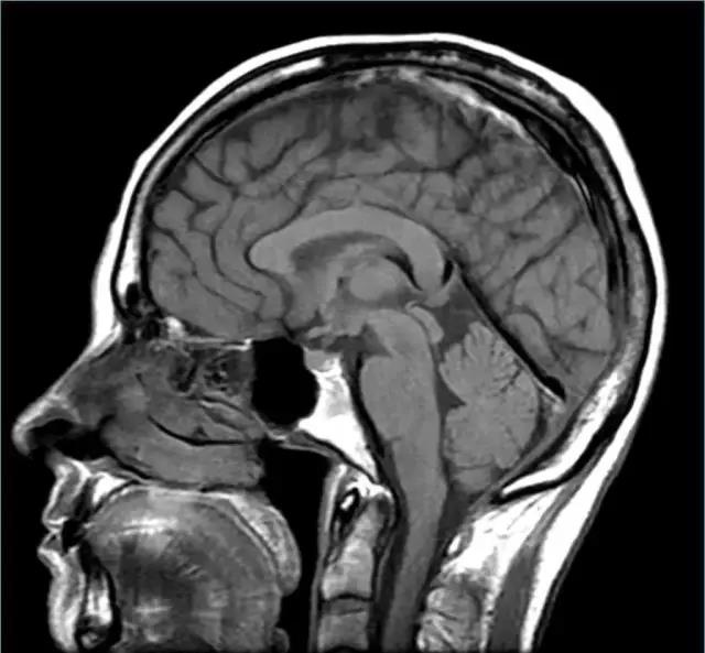 馬斯克腦機(jī)融合系統(tǒng)Neuralink